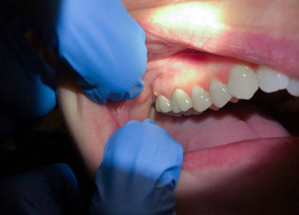 Best Urgent Tooth Repair  in Sunset, LA